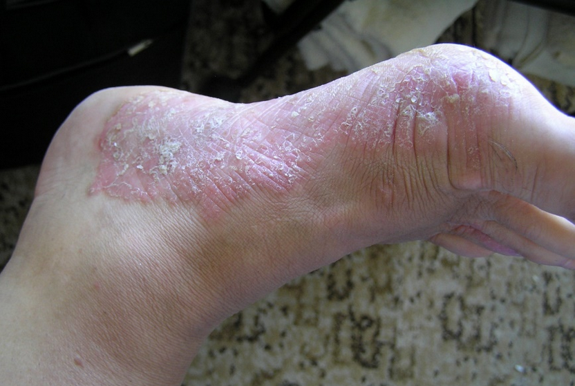 Psoriasis after 4 Laser Therapy treatments