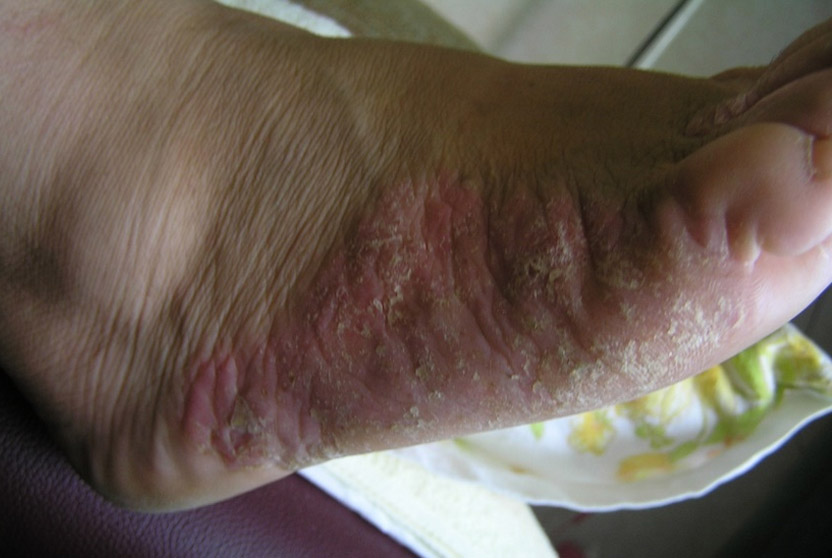 Psoriasis of the1 foot after 2ndt treatment with Laser